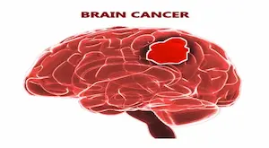 Brain tumor: Brain cancer is evident from chronic headaches.